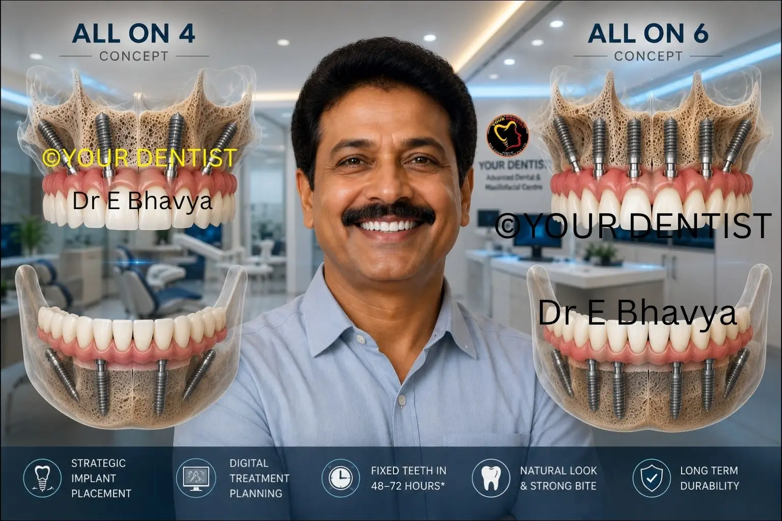 Comparison of All on 4 vs All on 6 Dental Implants in Vijayawada showing implant placement and full arch restorations