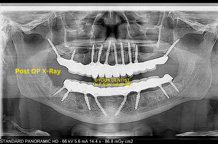 Basal & Cortical Implant - Post OP X ray