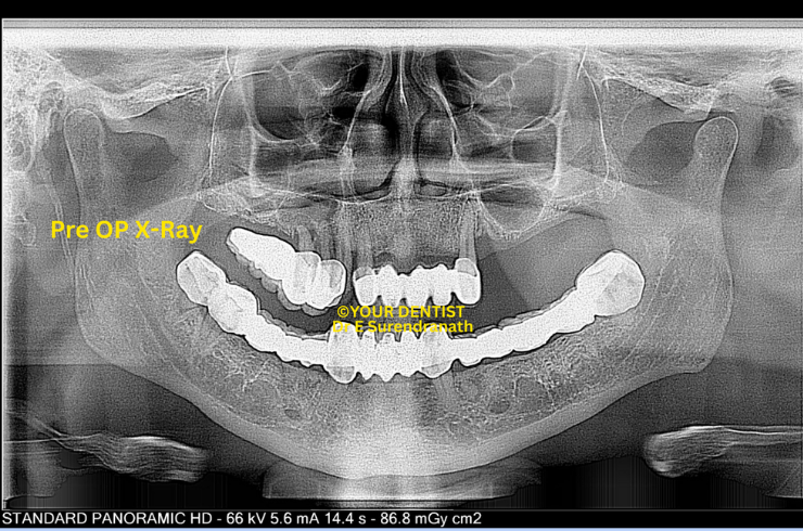 Basal & Cortical Implant - Pre OP X ray