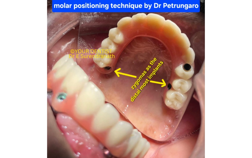 Zygomatic implants molar positioning technique by Dr Petrungaro