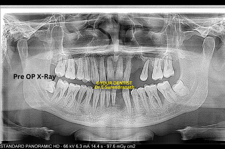 Patzi implant protocl - Pre OP Xray