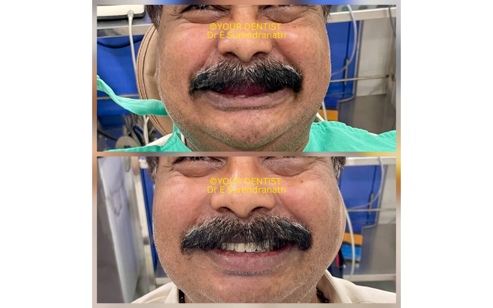Dental implant clinical outcome smile before and after