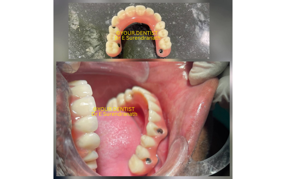 Full arch dental implant prosthesis intraoral view