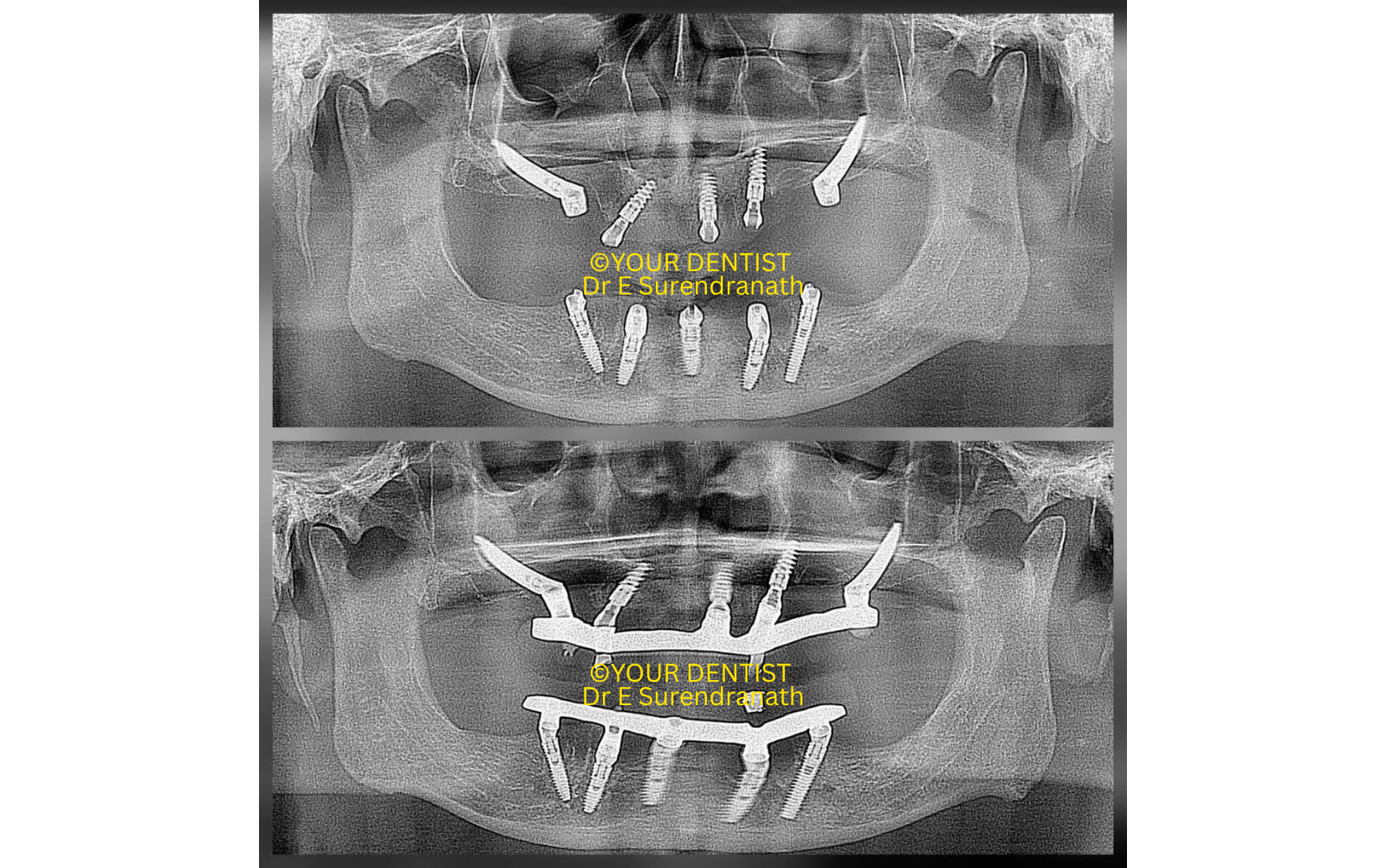 Full arch implant molar positioning X-ray