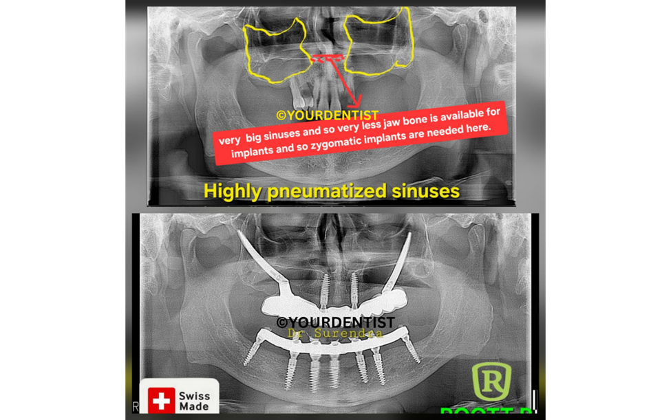 zygomatic implants highly pneumatized sinuses case 1