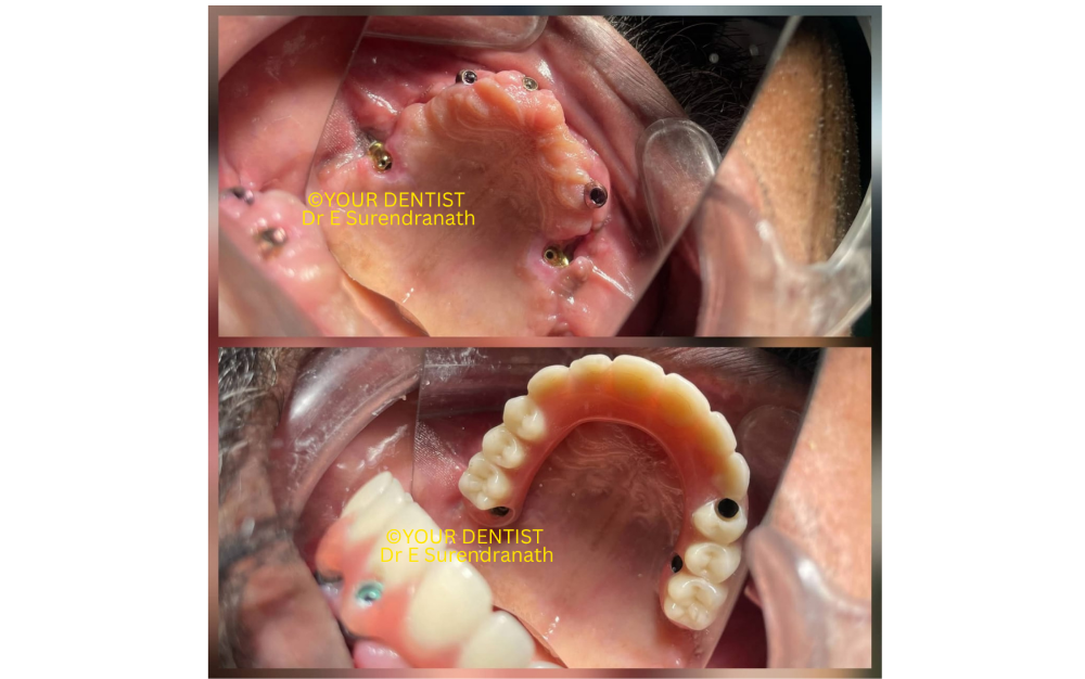 Immediate loading full arch dental implant prosthesis
