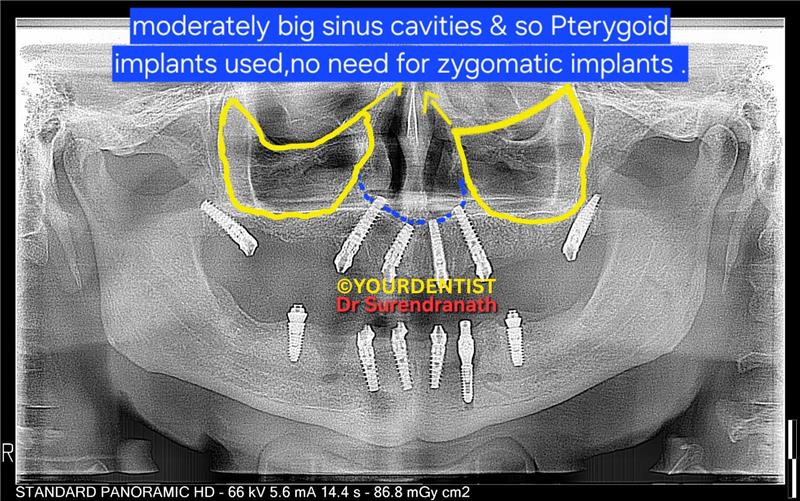 pterygoid implants maxillary sinus case