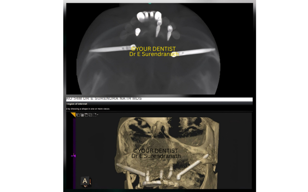 Full arch dental implant prosthesis intraoral view